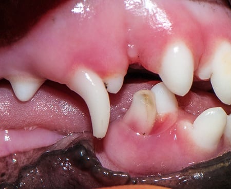 Dents de lait inférieures fracturées